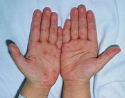 Vi rút EV71 đã có mặt khắp toàn quốc